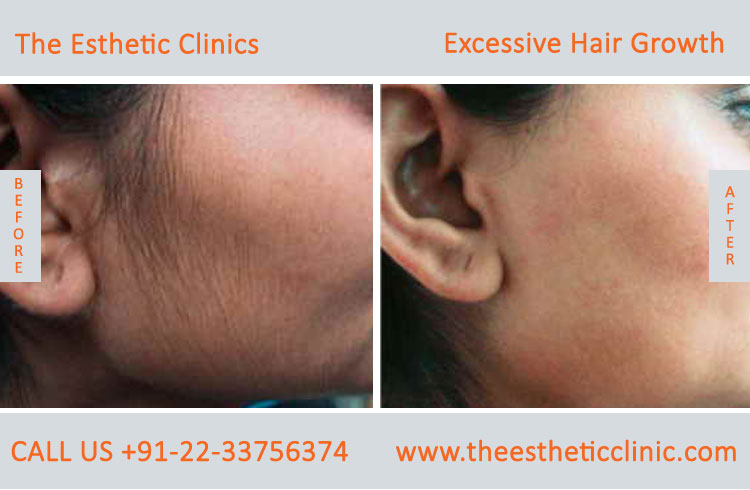 Excessive Hair Growth Removal Treatment before after photos in mumbai india (3)